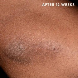 Skinceuticals Advanced Scar Control 50 Ml