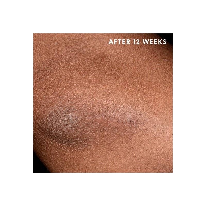 Skinceuticals Advanced Scar Control 50 Ml