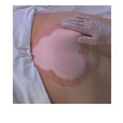 Allevyn sacrum 22,5X22,1 cm...